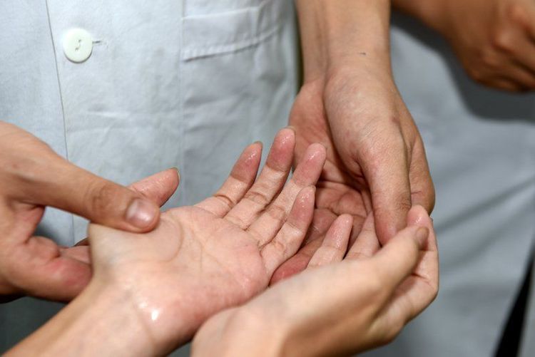 
Đổ mồ hôi tay chân liên tục có thể do rối loạn thần kinh thực vật
