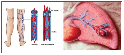 
Xét nghiệm d dimer chẩn đoán các bệnh lý huyết khối
