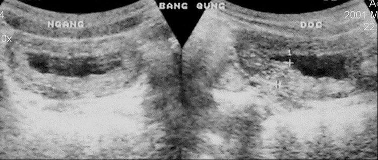 
Siêu âm giúp chẩn đoán bệnh polyp cổ bàng quang
