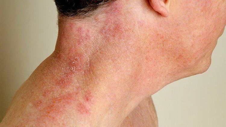 
Zona thần kinh có thể xuất hiện bất cứ vị trí nào trên cơ thể
