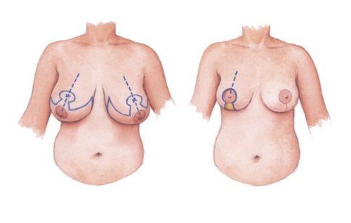 
Một phương pháp xử lý phì đại tuyến vú ở nữ là thu gọn tuyến vú có bảo tồn
