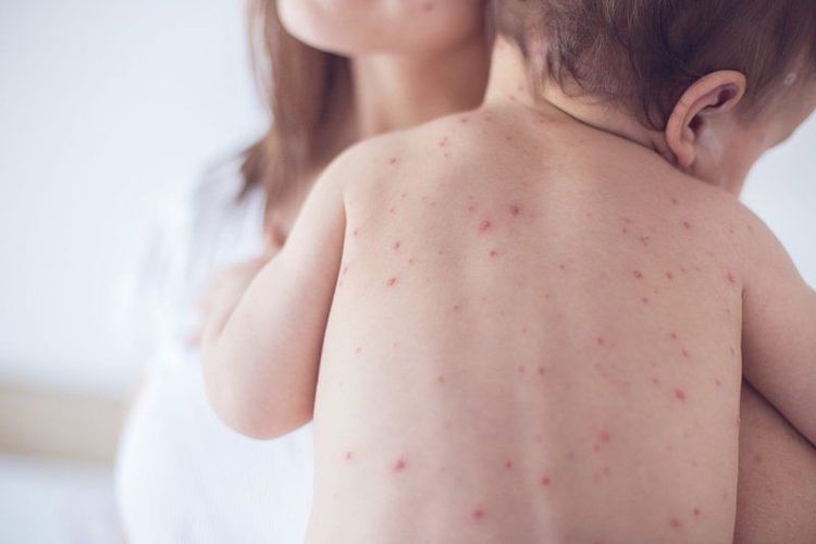 Trẻ sốt xuất huyết ngày thứ 3 chân tay lạnh nên làm gì?