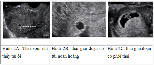 Một số cập nhật về siêu âm chẩn đoán chửa ngoài tử cung