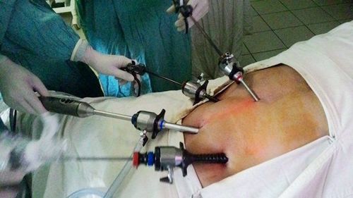 
Thực hiện phẫu thuật nội soi lấy dị vật ở ruột non
