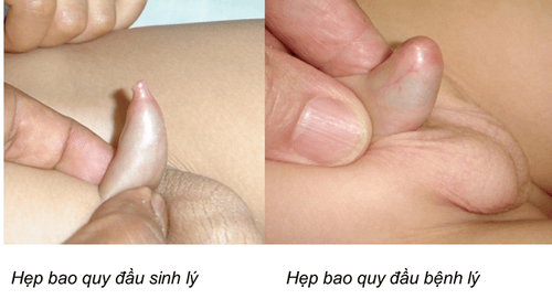 
Hẹp bao quy đầu ở trẻ có thể làm tăng nguy cơ viêm niệu đạo
