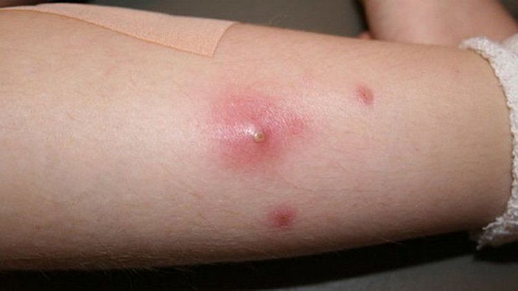 
Nhiễm khuẩn khiến chỗ tiêm bị sưng , nóng và đau
