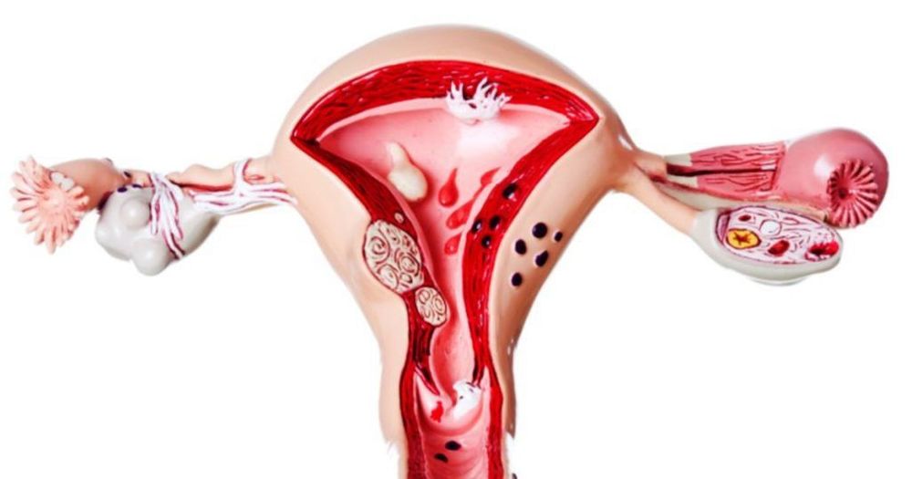 
Endo Belly cảm giác khó chịu ở bụng do lạc nội mạc tử cung
