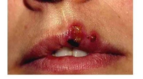 
Vết loét lạnh gây ra những nốt sần trên da
