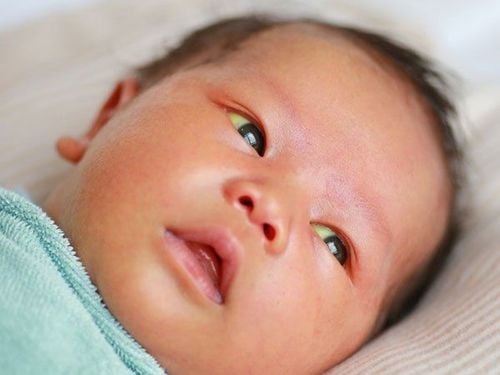 
Một số bệnh lý có thể khiến chỉ số bilirubin trong máu trẻ sơ sinh tăng cao
