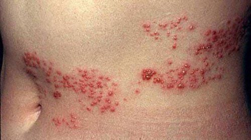 
Nhiễm HIV khi quan hệ tình dục khiến người bệnh mắc Zona thần kinh
