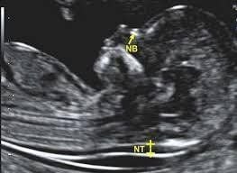 Siêu âm đo độ mờ da gáy giúp phát hiện thai nhi có khả năng mắc hội chứng Down hay không. 