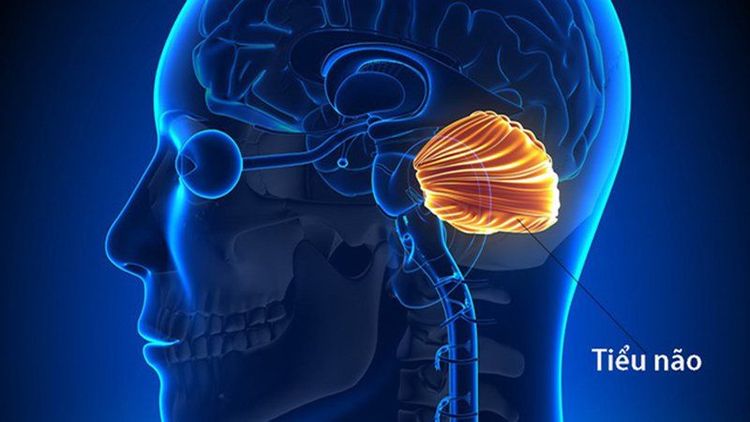 
Hội chứng tiểu não là triệu chứng lâm sàng của hội chứng cô lập về mặt lâm sàng (CIS)
