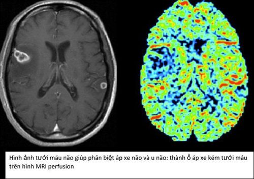 Chụp cộng hưởng từ tưới máu não (MRI perfusion) - P1