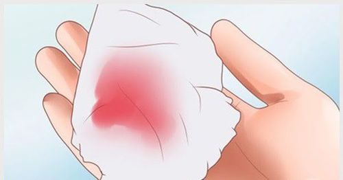 
Khi hư ra nhiều là biểu hiện của viêm lộ tuyến cổ tử cung độ 2
