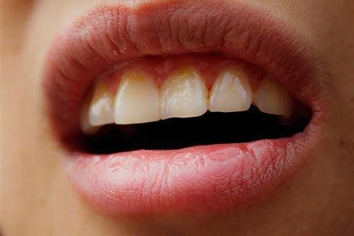 
Mất nước ở người lớn có thể gây khô miệng mệt mỏi

