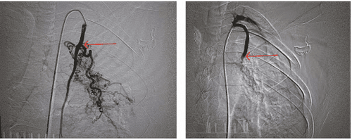 
Dưới hình ảnh của chụp mạch số hóa xóa nền, việc đặt stent niệu quản trở nên chính xác hơn

