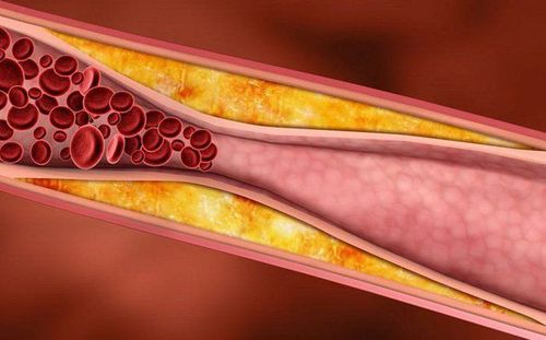 
Các bệnh về huyết áp có thể bị gây ra bởi xơ vữa động mạch
