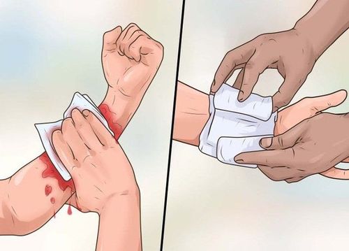 
Vết thương cần được băng ép
