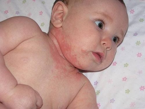 
Trẻ bị viêm da tiết bã do di truyền từ bố mẹ
