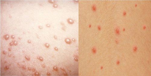 
Mụn nước dạng thủy đậu gây ảnh hưởng nghiêm trọng đến sức khỏe của trẻ

