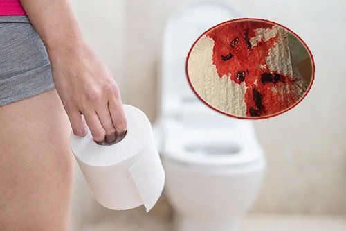 
Xuất hiện máu trong phân là một trong các dấu hiệu của bệnh Degos

