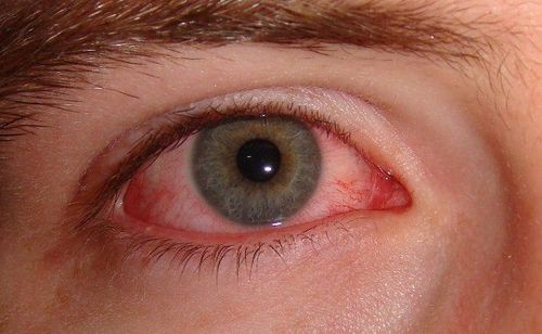 
Mắt đỏ là dấu hiệu nhận biết bạn bị khô mắt sau mổ Lasik
