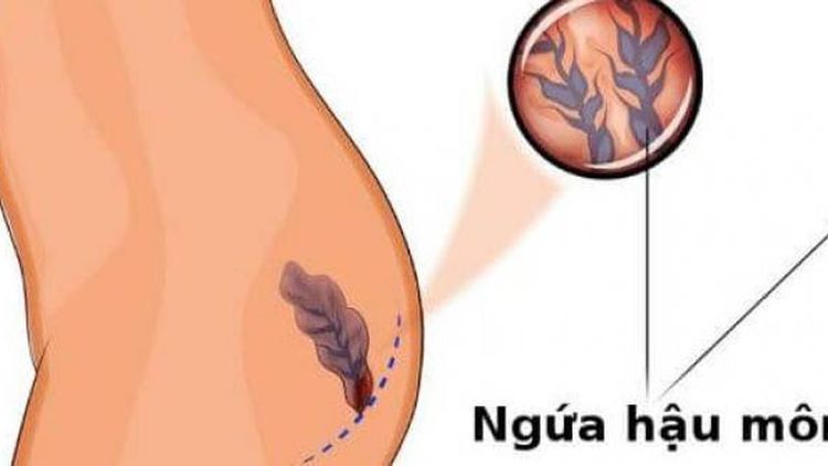 
Bệnh trĩ và ung thư đại trực tràng đều gây ngứa trực tràng hoặc hậu môn
