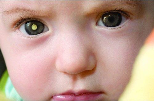 
Tỷ lệ bệnh lý võng mạc ở những trẻ sinh non là rất cao
