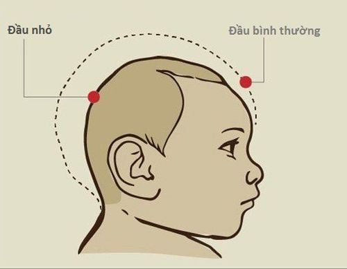 
Ngạt ở trẻ sơ sinh có thể gây biến chứng đầu nhỏ trong tháng đầu tiên sau sinh
