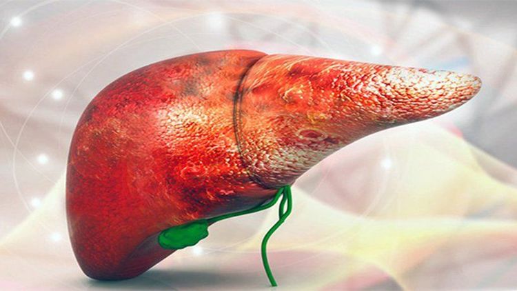 
Tăng men gan là triệu chứng cận lâm sàng của hội chứng
