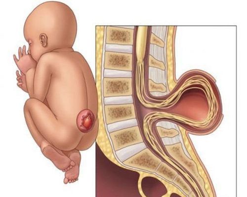 
Thoát vị màng não tủy là bệnh lý rất nguy hiểm

