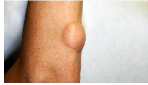 
Lipoma là dạng u mềm khi chạm vào và di chuyển dễ dàng nếu bạn dùng ngón tay ấn vào
