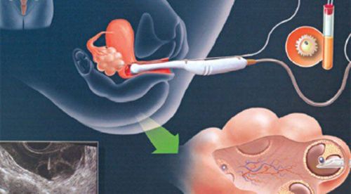 
Người vợ sẽ được dùng thuốc kích thích buồng trứng trong khoảng 9-11 ngày
