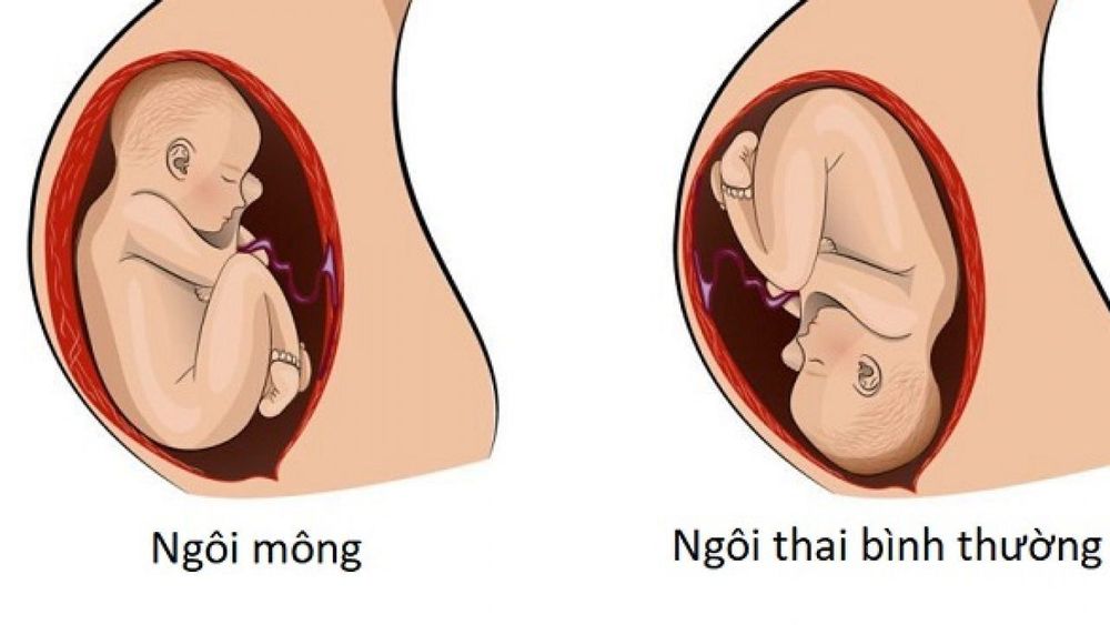 
Sản phụ sinh ngôi môi tăng nguy cơ sinh con trật khớp háng bẩm sinh
