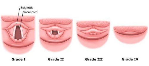 
Hình 2 – Phân độ Cormack và Lehance
