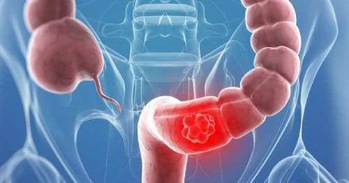 
Tỷ lệ sống sót sau 5 năm của bệnh nhân ung thư trực tràng là khoảng 66%
