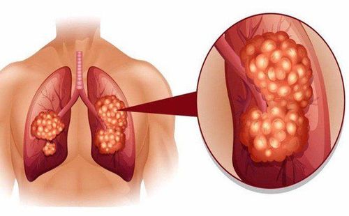 
Ngồi lâu có thể dễ bị ung thư phổi
