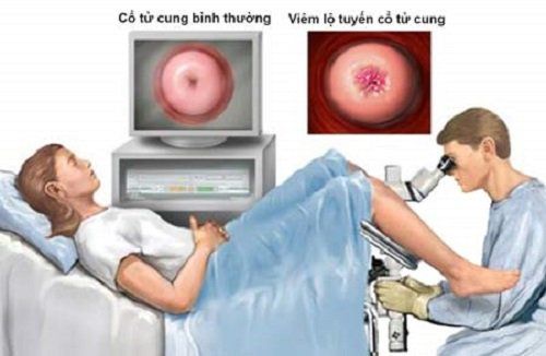 Phương pháp áp lạnh sẽ khiến cho các mô hoại tử của viêm loét chết đi và bong ra
