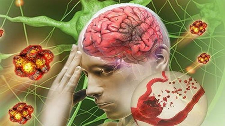 
Tai biến mạch máu não là một trong các yếu tố khởi phát cơn sảng rượu

