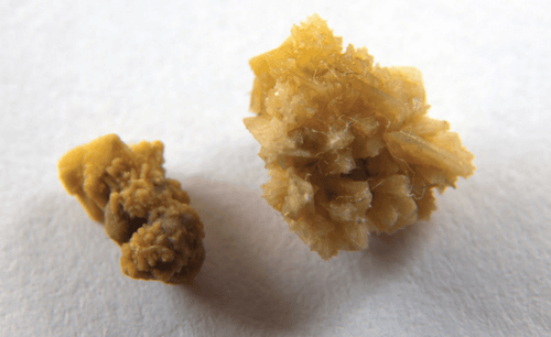 Không điều trị nội khoa sỏi tiết niệu khi kích thước viên sỏi trên 7mm