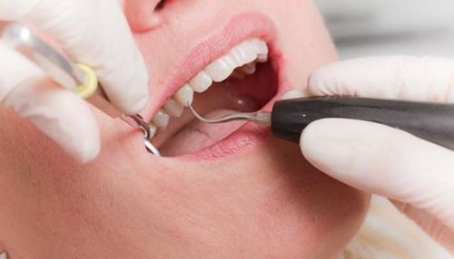 
Khi nào cần trám răng thì bác sĩ sẽ là người quyết định giúp bạn
