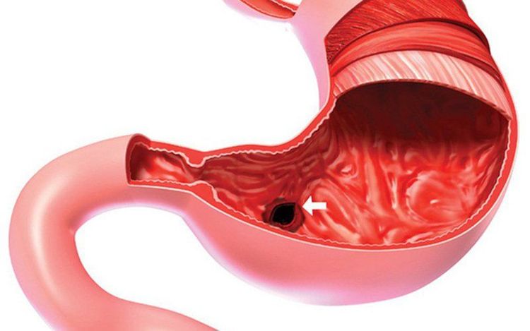 
Loét dạ dày tá tràng có biến chứng nặng sẽ được chỉ định cắt bỏ
