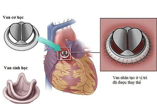 
Thay van tim cơ học và sinh học là biện pháp thường được áp dụng
