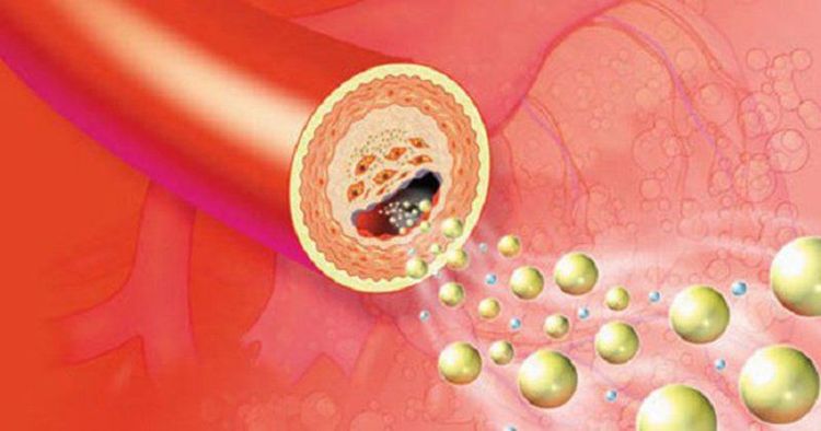 
Người bệnh kiểm soát rối loạn lipid máu giúp giảm các biến chứng mỡ động mạch
