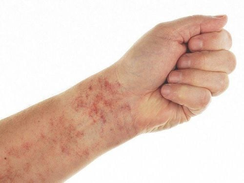 
Bệnh giảm tiểu cầu vô căn với những vết bầm tím ở khắp cơ thể
