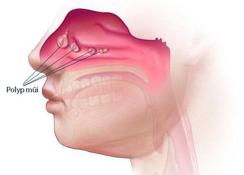 
Nạo sàng xoang mũi được chỉ định khi phẫu thuật đồng thời với cắt polyp mũi
