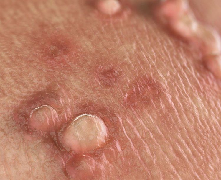 
Mụn cóc sinh dục là một triệu chứng phổ biến của virus HPV
