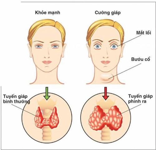 
Cường giáp là một trong 2 bệnh lý thường gặp ở tuyến giáp
