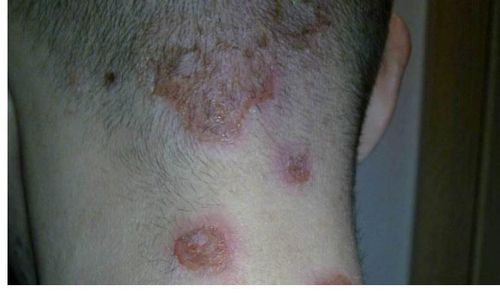 
Chốc lở gây ra những nốt sần trên da
