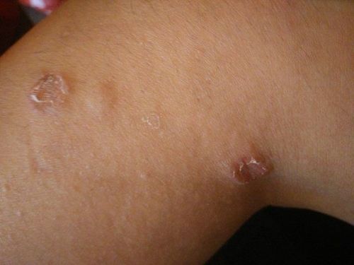 
Chẩn đoán một vết loét do tì đè không gặp quá nhiều khó khăn
